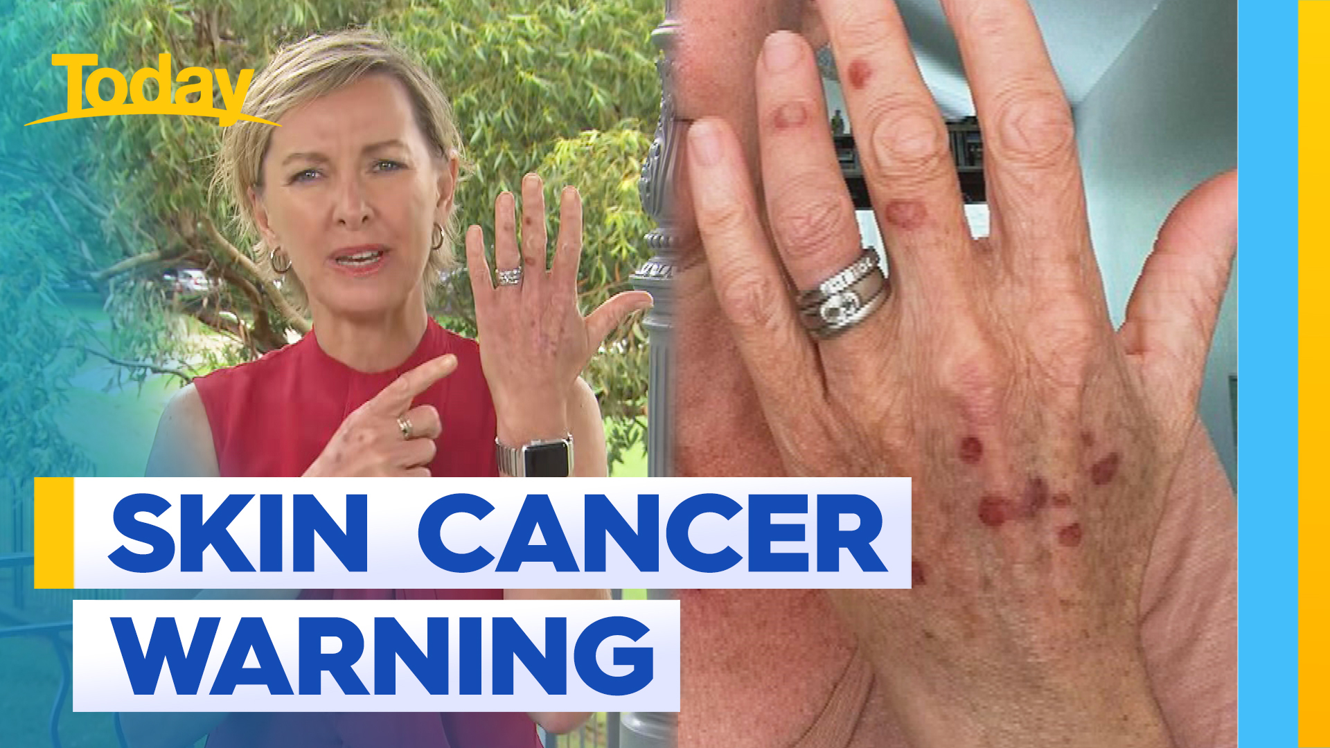 Deb Knight's tanning warning after pre-cancer spots removed